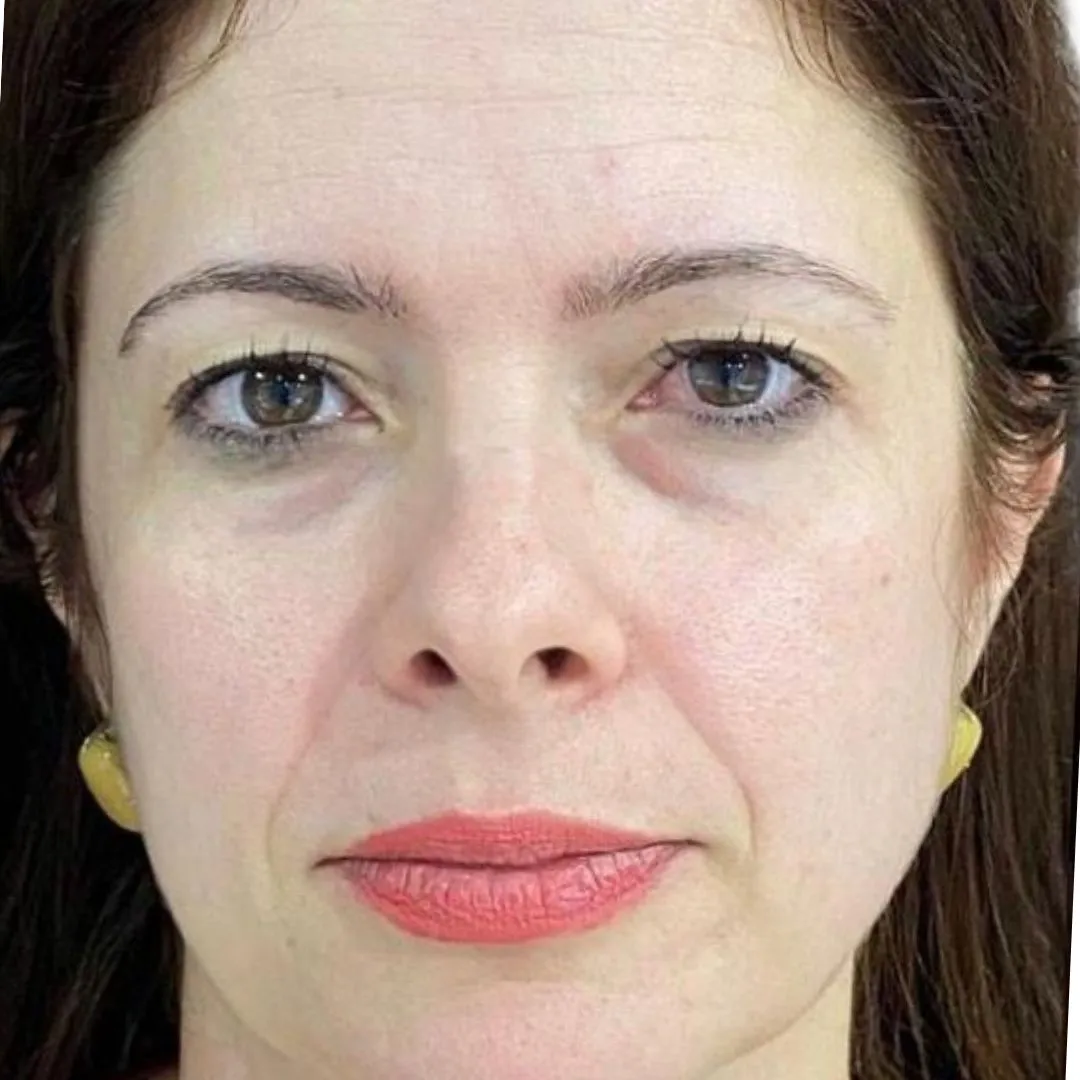 Rosto-antes Rosto-antes
